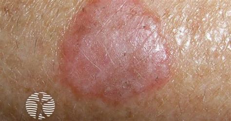 Lichenoid Keratosis Image