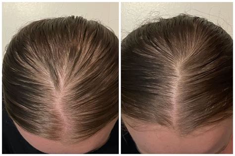 Minoxidil Before And After Men