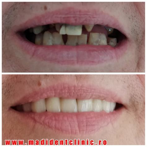 Reabilitare Oral Total Ceramic Clinica Stomatologic Madident Alba