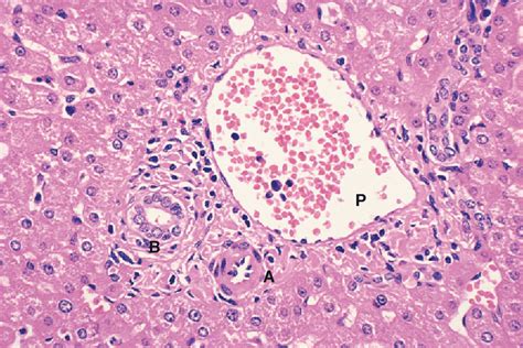 Figure 111 From Sherlocks Diseases Of The Liver And Biliary System