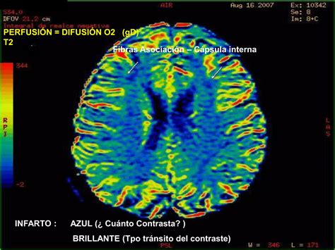 Pnie Psico Neuro Inmuno Endocrino Sindrome Fatiga Cronica Fibromialgia