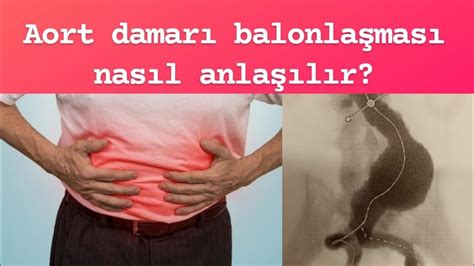 Aort damarı balonlaşması Aort anevrizması muayene ile nasıl anlaşılır