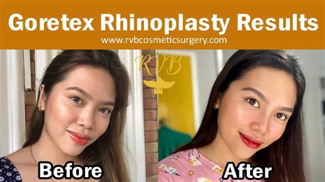 Goretex Rhinoplasty Journey Natural Looking Nose Youtube