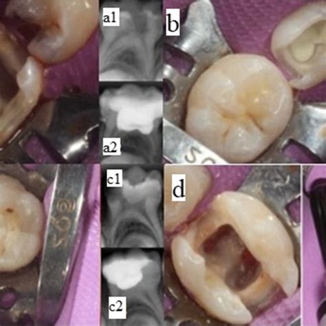 Twelve Month Postoperative Periapical Radiographs Of The Same Teeth