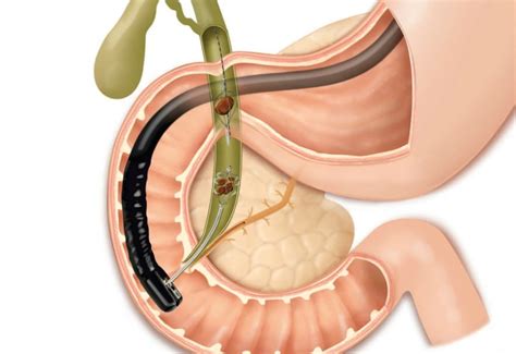 Marzo 25 2017 Endoscopiadigestiva It Di Felice Cosentino Per