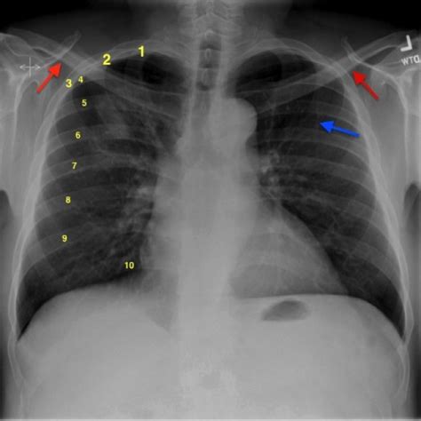 Interpreting A Chest X Ray Stepwards