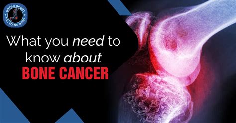 What You Need To Know About Bone Cancer