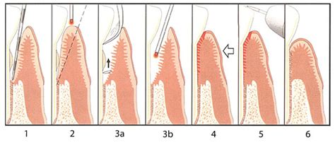 Taking Advantage Lanap Non Surgical Periodontal Disease Treatment