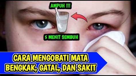 Cara Menyembuhkan Mata Bengkak Obat Mata Bengkak YouTube