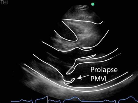 Causes of Mitral Valve Regurgitation - Critical Care Sonography