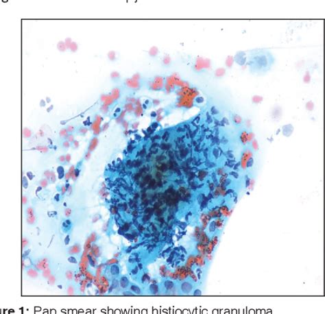 Figure 1 From Recurrent Pyometra And Xanthogranulomatous Salpingitis A