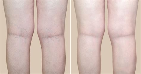 Spider Veins On Legs Treatment