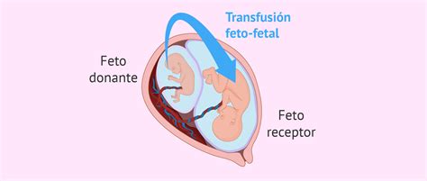 Sindrome De Transfus O Feto Fetal