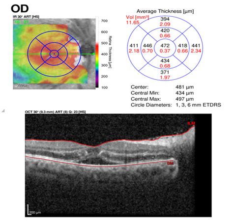 Oct Macula Right Eye Showed Subfoveal Subretinal Uid Download