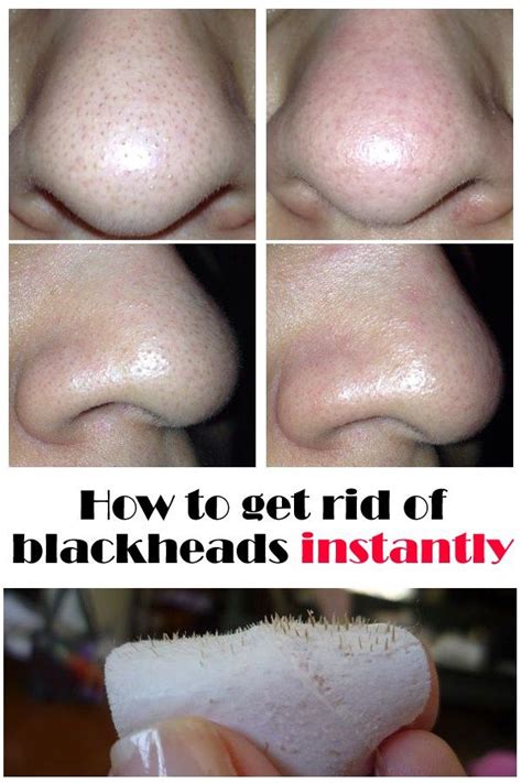 How To Get Rid Of Blackheads Beauty Glamour Nose Pores Clogged Pores On Nose Clean Nose Pores