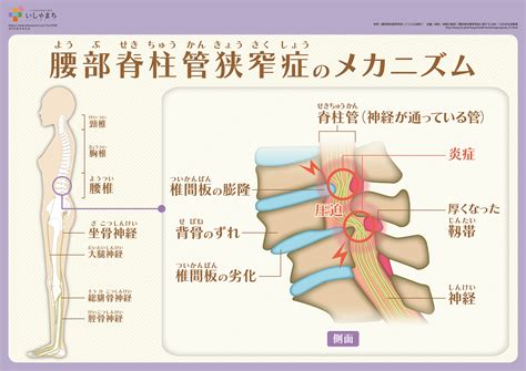 腰部脊柱管狭窄症のメカニズム いしゃまち