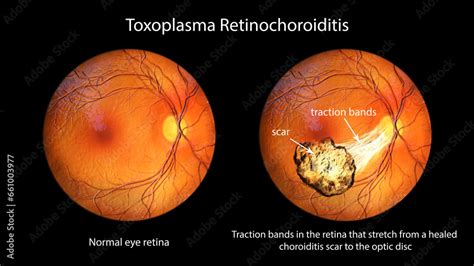 Toxoplasma Retinochoroiditis Observed During Ophthalmoscopy D