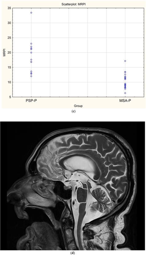 Figure 1 From The Strengths And Obstacles In The Differential Diagnosis Of Progressive