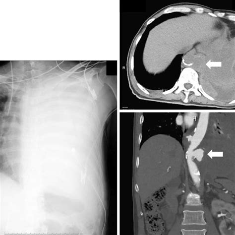 Figure1 Chest Radiography And Computed Tomography Images Obtained On