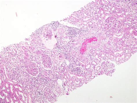 Renal Biopsy Light Microscopy Hematoxylin And Eosin An Interlobular