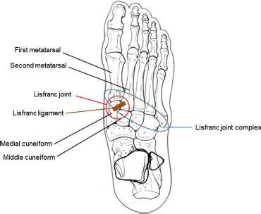 Anatomy of a Lisfranc Injury – My Frenemy, Lisfranc