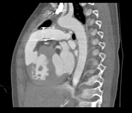 Right Ventricle To Pulmonary Artery Conduit In A Tetralogy Of Fallot