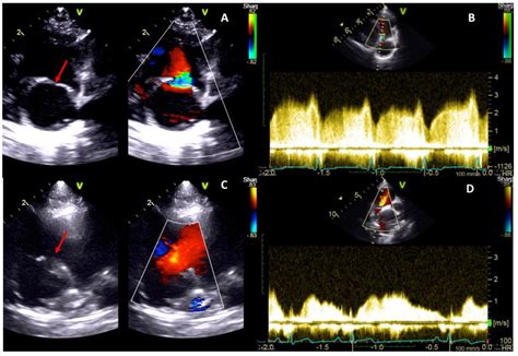 Percutaneous Balloon Dilation In Two Dogs With Cor Triatriatum Dexter