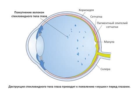 Мушки перед глазами - причины, правильное лечение и последствия