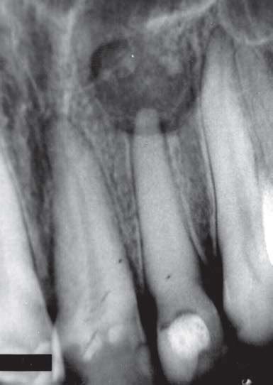 Radiograph Taken Month After The Beginning Of The Nonsurgical Root