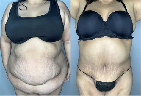 Patient 68004101 Liposuction Before And After Photos Arroyo Plastic