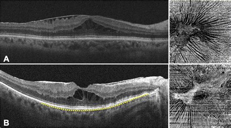 Epiretinal Membrane Oct