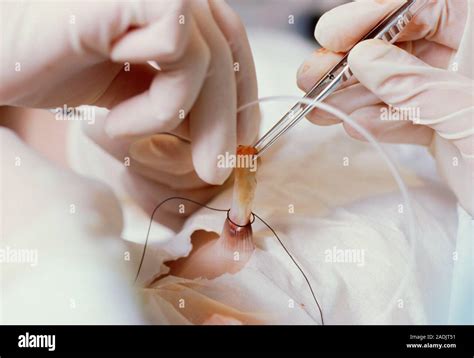 Model Released Umbilical Venous Catheter Uvc Being Inserted Into The Umbilical Cord Stump Of