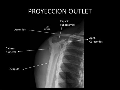 Informe radiológico Proyecciones fundamentales en la radiografía de hombro