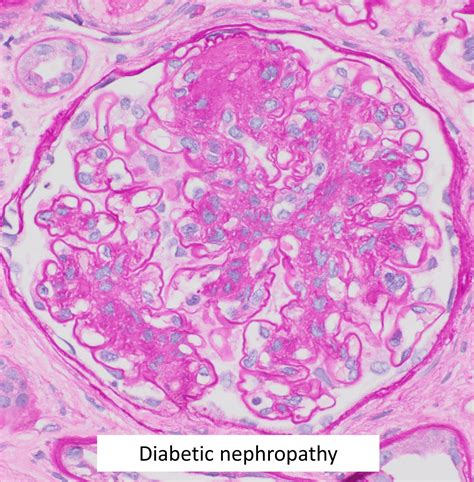 Diabetic Nephropathy Diabetic Glomerulosclerosis Mypathologyreportca