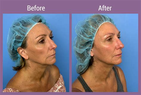 Novathreads Facelift Alternative Allura Skin Laser And Wellness Clinic