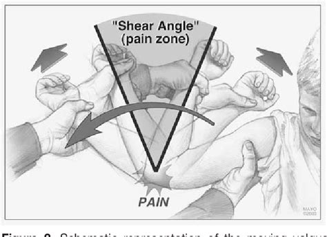 Figure 2 From The “moving Valgus Stress Test” For Medial Collateral Ligament Tears Of The Elbow