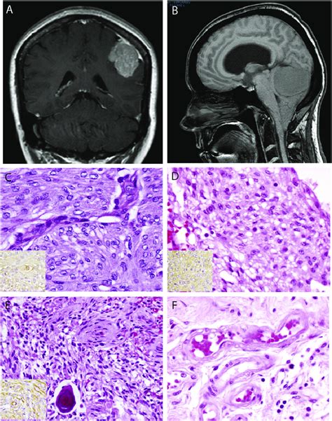 Mri Location And Histologic Appearance Of Meningiomas Occurring In Download Scientific Diagram