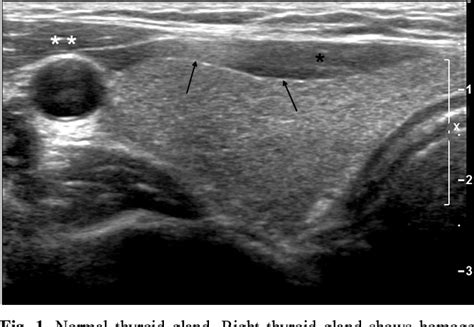 Figure 1 From Sonographic Evaluation Of Thyroid Nodules Semantic Scholar