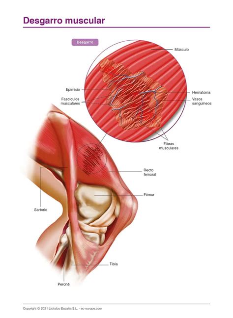 Desgarro Muscular