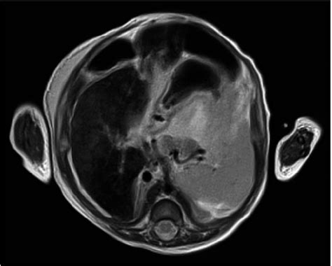 Abdominal Magnetic Resonance Imaging T2 Weighted Image Demonstrated