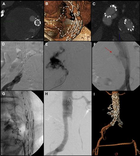 Patient 5 Preoperative Computed Tomography A And Volume Rendering