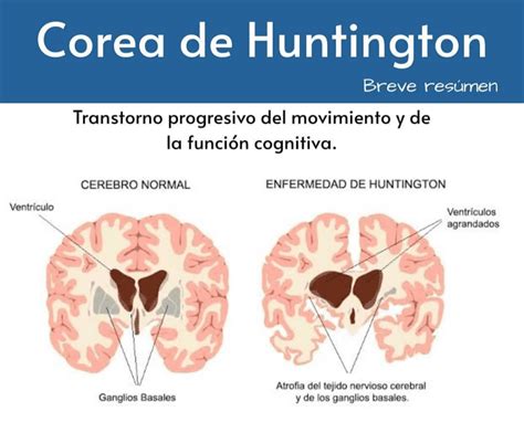 Corea De Huntington Y Ejercicio F Sico Integra Da O Cerebral