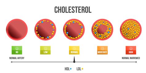 High Cholesterol Overview Types Symptoms Causes Levels And More