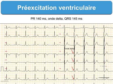 Préexcitation 1 Généralités E Cardiogram