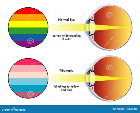 Tritanopia Stock Image Image 27568141