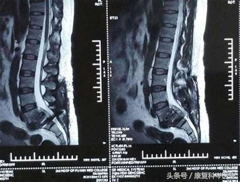 要確診腰椎間盤突出到底是做x片、ct還是磁共振？看完你就懂了 每日頭條