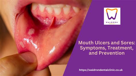 Mouth Ulcers And Sores Symptoms Treatment And Prevention Waldron