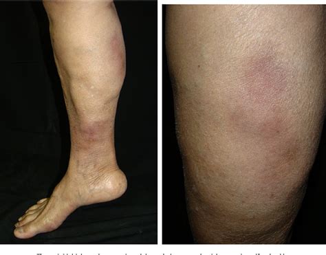 Figure From Pulmonary Mycobacterium Abscessus Infection Induced