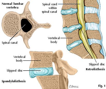 What Is Retrolisthesis - Health With Nature