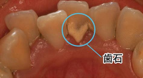歯垢（プラーク）と歯石の落とし方｜歯の健康基礎知識｜ライオン